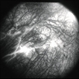 Staining of retinal vessels, leakage from peripheral retinal neovascularization and peripheral nonperfusion